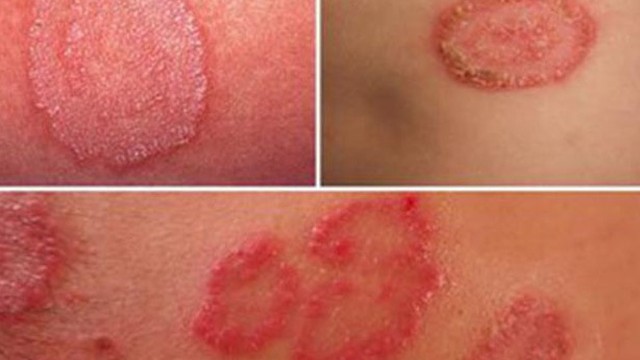 bai-viet/top-5-cach-chua-hac-lao-o-hang-theo-dan-gian-hieu-qua-nhanh-chong-55460.html