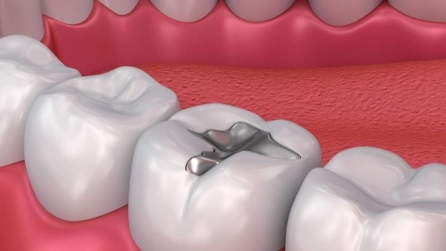 bai-viet/tram-rang-roi-co-tay-trang-duoc-khong-cach-cham-soc-rang-luon-trang-sang.html