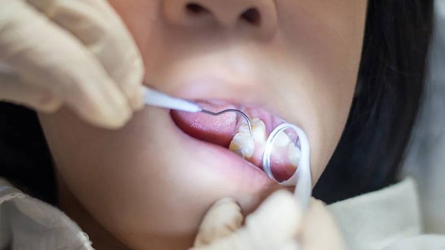 bai-viet/tram-rang-sau-lo-to-bao-nhieu-tien-cac-yeu-to-anh-huong-den-chi-phi.html