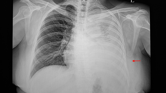 benh/tran-dich-mang-phoi-175.html