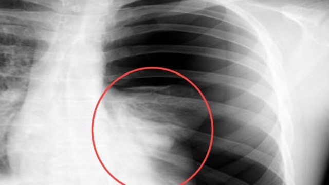 bai-viet/tran-dich-mang-phoi-co-nguy-hiem-khong-cach-xu-ly-nhu-the-nao.html