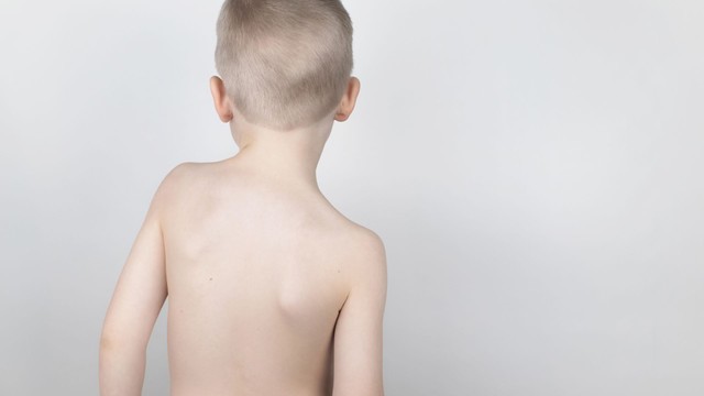 bai-viet/tre-bi-coi-xuong-nen-bo-sung-gi-cach-bo-sung-che-do-an-cho-tre-bi-coi-xuong.html