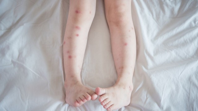 bai-viet/tre-bi-noi-man-do-o-chan-la-benh-gi-cach-dieu-tri-ra-sao.html