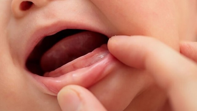 bai-viet/tre-cham-moc-rang-nen-uong-thuoc-gi.html