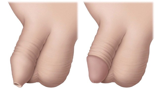 bai-viet/tre-em-nen-dung-thuoc-boi-hep-bao-quy-dau-nao.html