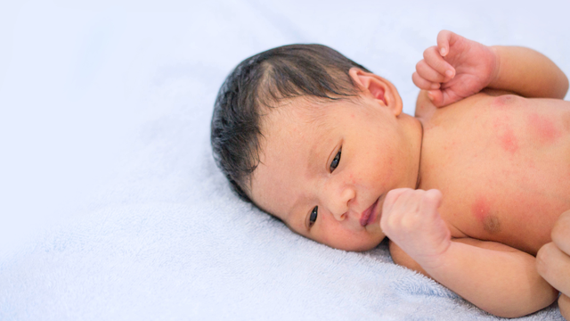 bai-viet/tre-phat-ban-sau-tiem-6in1-phai-lam-sao-cach-cham-soc-tre-sau-tiem-phong.html