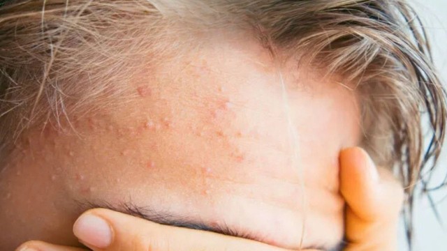 bai-viet/tri-mun-an-duoi-da-nhu-the-nao-de-mang-lai-hieu-qua-an-toan.html