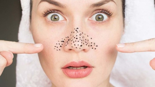 bai-viet/tri-mun-dau-den-o-mui-bang-bha-va-nhung-luu-y-can-biet.html