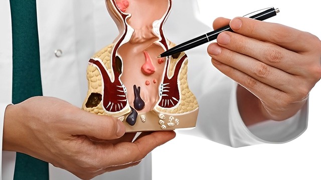 bai-viet/benh-tri-noi-do-1-co-nguy-hiem-khong-cach-dieu-tri-ra-sao.html