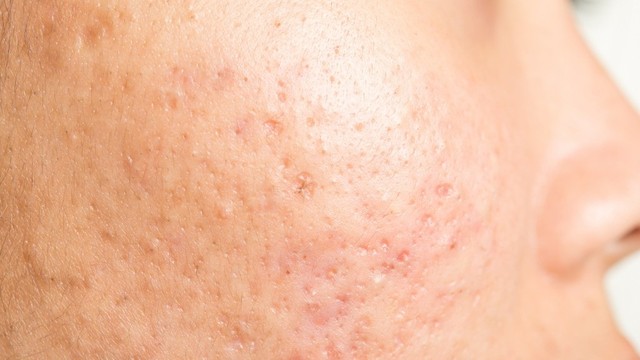 bai-viet/tri-seo-ro-gia-bao-nhieu-cac-phuong-phap-tri-seo-ro-pho-bien-hien-nay.html