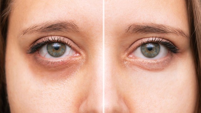 bai-viet/tim-hieu-chi-tiet-ve-quy-trinh-tri-tham-mat-bang-laser.html