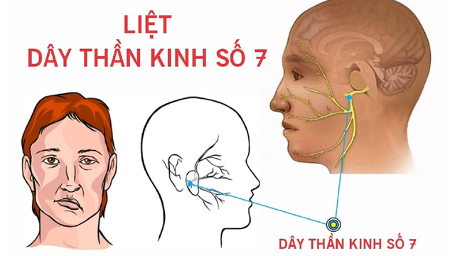 bai-viet/trieu-chung-liet-day-than-kinh-so-7-la-gi-60397.html