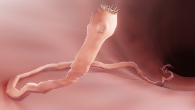 bai-viet/giun-dep-va-cac-trieu-chung-khi-nhiem-cach-chan-doan.html