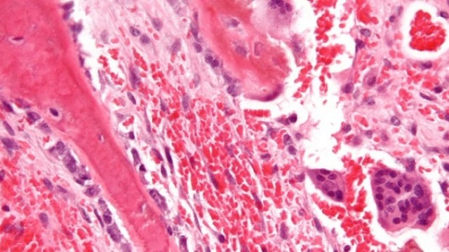 bai-viet/trieu-chung-tang-canxi-mau-trong-ung-thu-54234.html