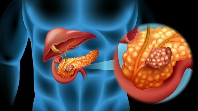 bai-viet/nhung-trieu-chung-ung-thu-tuyen-tuy-giai-doan-dau.html