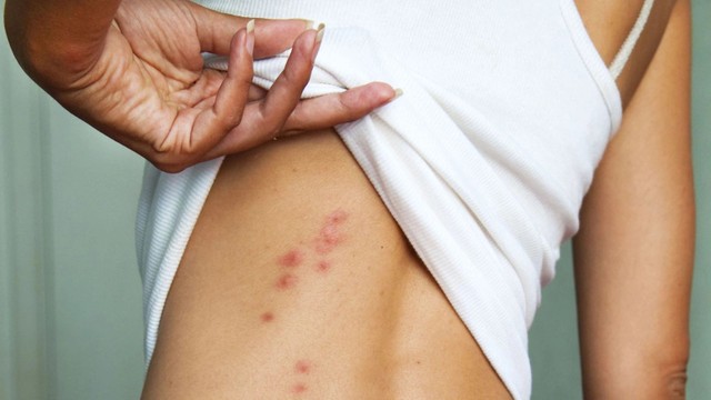 bai-viet/trieu-chung-va-dien-tien-benh-thuy-dau-o-nguoi-lon.html