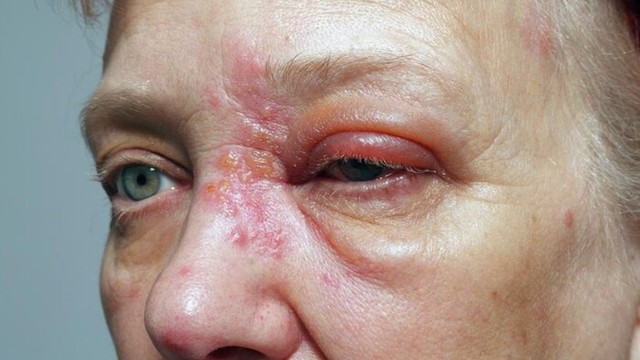 bai-viet/trieu-chung-zona-than-kinh-o-mui-va-cach-dieu-tri.html