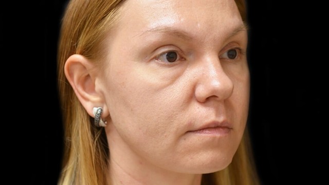 bai-viet/trung-ma-malar-mound-la-gi-phuong-phap-cham-soc-tai-nha-cho-trung-ma-malar-mound.html