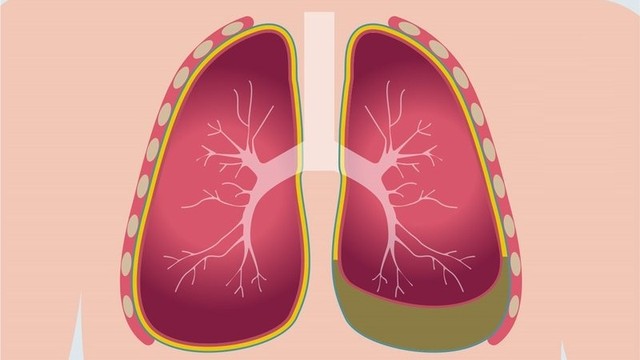 bai-viet/truong-hop-dich-mang-phoi-mau-do-la-gi.html