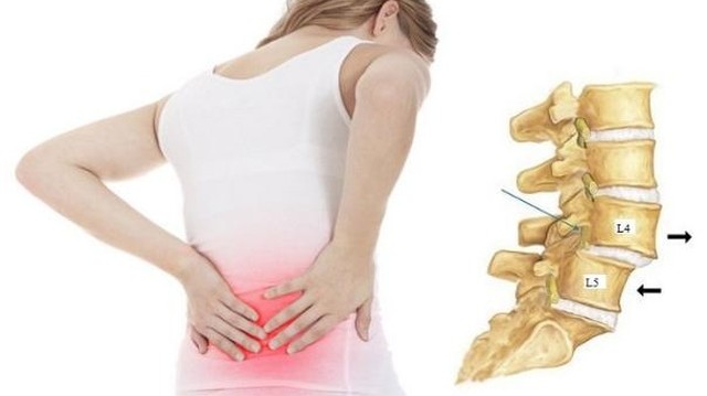 bai-viet/truot-dot-song-ra-truoc-l4-l5-va-nhung-dieu-can-biet.html