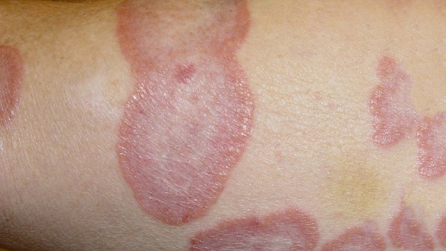 bai-viet/tu-van-da-lieu-ghe-lo-hac-lao-co-lay-khong-57065.html