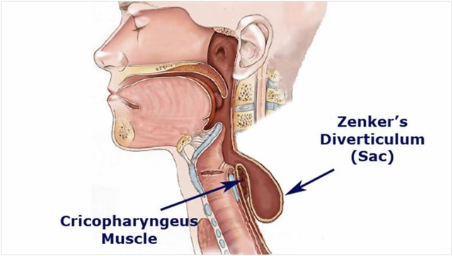 bai-viet/tui-thua-zenker-la-gi-phuong-phap-chan-doan-va-dieu-tri-hieu-qua.html