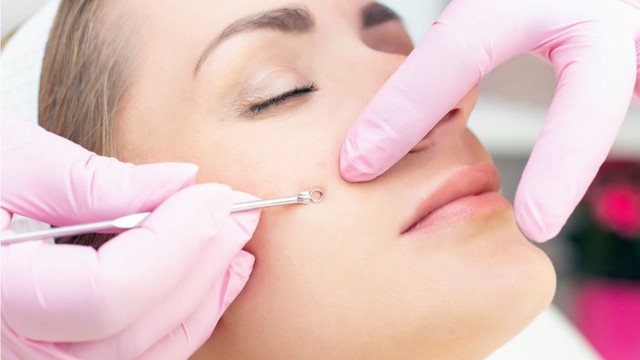 bai-viet/tuoi-day-thi-co-nen-di-spa-nan-mun-khong-mot-so-luu-y-can-biet-sau-khi-nan-mun.html