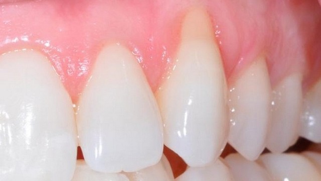 bai-viet/tut-loi-khi-boc-rang-su-la-vi-sao-co-cach-khac-phuc-khong-55288.html