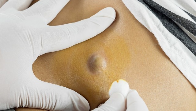 bai-viet/u-ba-dau-co-nguy-hiem-khong-phuong-phap-dieu-tri-va-phong-ngua-u-ba-dau.html