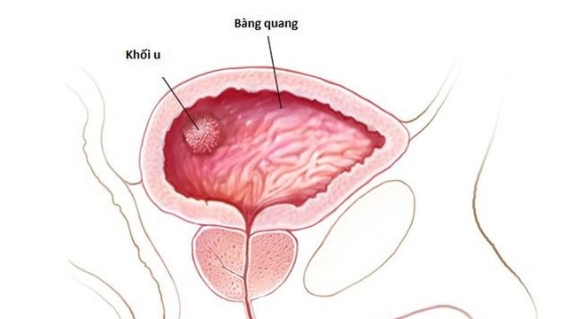 bai-viet/u-bang-quang-lanh-tinh-khai-niem-phan-loai-trieu-chung-va-muc-do-nguy-hiem.html