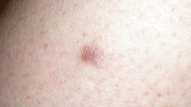 bai-viet/u-co-tron-o-da-la-gi-trieu-chung-va-cach-dieu-tri.html