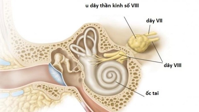 bai-viet/u-day-than-kinh-so-8-la-gi-trieu-chung-va-cach-dieu-tri-57654.html