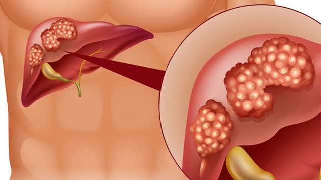 bai-viet/u-gan-la-gi-can-nguyen-va-cac-dau-hieu-nhan-biet-khoi-u-gan-lanh-tinh-va-ac-tinh.html