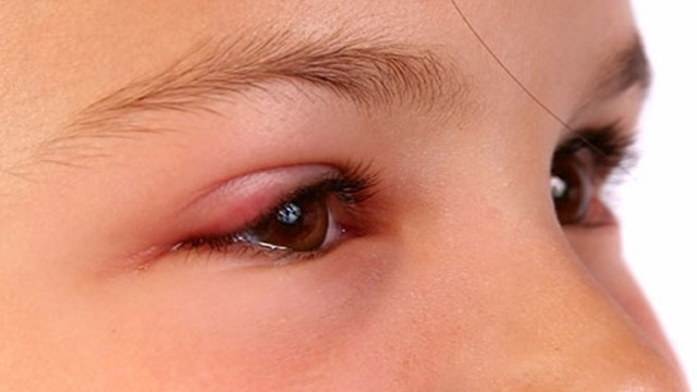 bai-viet/u-hoc-mat-benh-ly-ve-mat-ban-khong-nen-xem-nhe.html