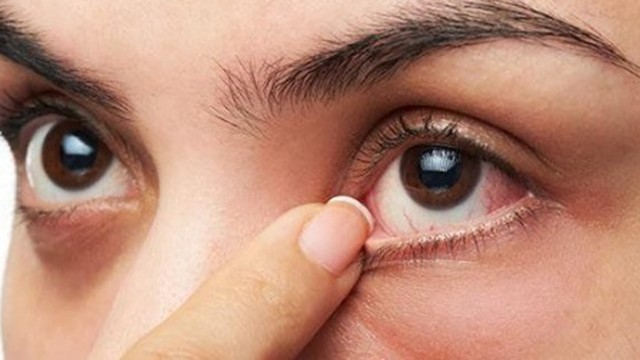 bai-viet/u-ket-mac-mat-nguyen-nhan-phan-loai-cach-dieu-tri-va-phong-ngua-benh.html