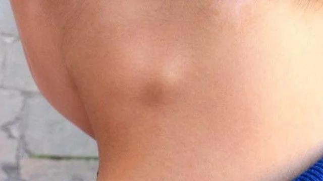 bai-viet/u-lympho-ac-tinh-khong-hodgkin-la-gi-va-dau-hieu-nhan-biet.html