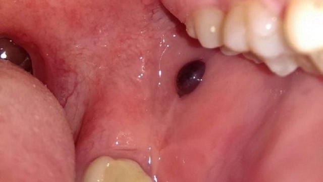 bai-viet/u-mau-trong-mieng-la-gi-co-nguy-hiem-khong.html