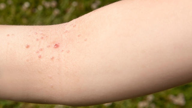 benh/u-mem-lay-534.html