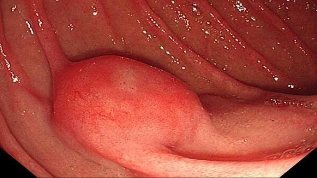 bai-viet/u-mo-dem-duong-tieu-hoa-gist-nhung-cau-benh-nhan-nen-hoi-doi-ngu-cham-soc-y-te-53927.html