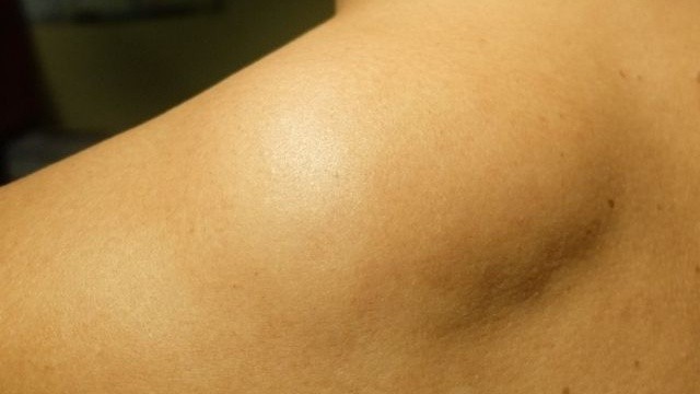 bai-viet/u-mo-o-vai-la-benh-gi-u-mo-o-vai-co-nguy-hiem-khong.html