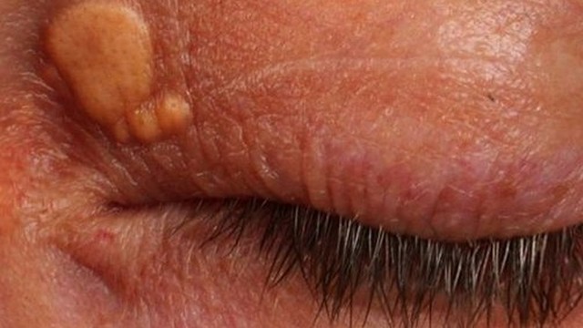 bai-viet/u-mo-vang-o-mat-nguyen-nhan-va-cach-dieu-tri.html