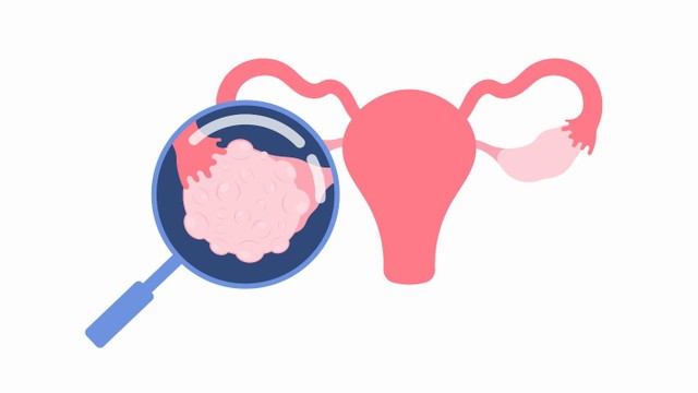 bai-viet/u-nang-va-u-xo-co-gi-khac-biet-giua-hai-loai-u-nay.html