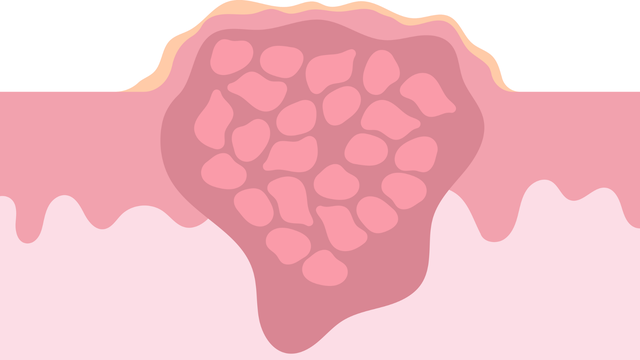 u nguyên bào xơ cơ viêm