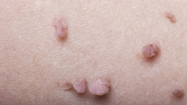 bai-viet/u-nhu-tren-da-co-nguy-hiem-hay-khong-phuong-phap-dieu-tri-u-nhu.html