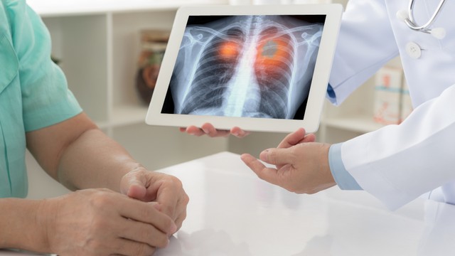 bai-viet/u-phoi-ac-tinh-va-nhung-dieu-can-biet.html