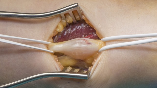 bai-viet/u-schwannoma-nguyen-nhan-trieu-chung-chan-doan-va-phuong-phap-dieu-tri.html