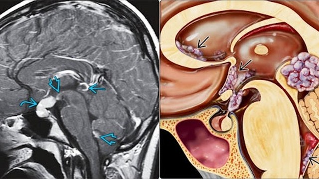 bai-viet/u-te-bao-mam-o-tre-em-gioi-thieu-59177.html