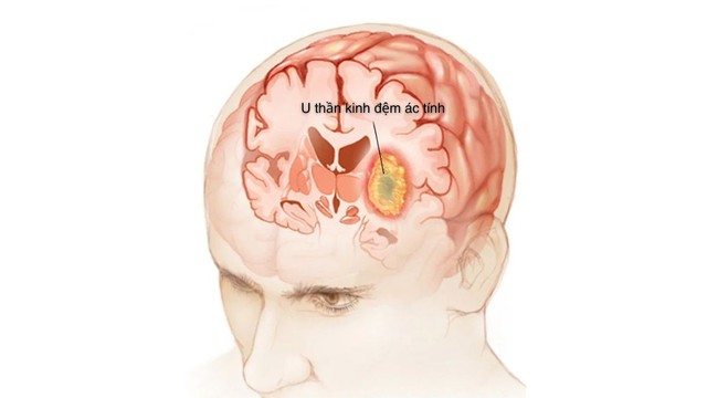 bai-viet/u-than-kinh-dem-ac-tinh-dau-hieu-nhan-biet-nguy-co-va-cach-dieu-tri.html