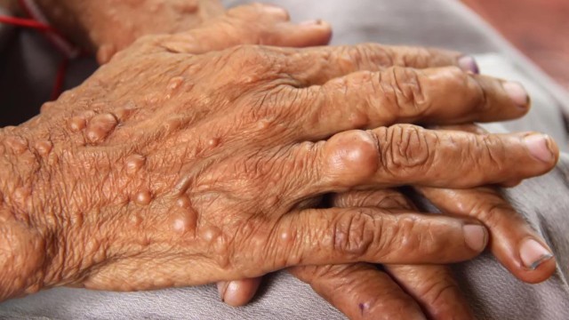 bai-viet/u-than-kinh-ngoai-bien-nguyen-nhan-va-trieu-chung-dang-lo-ngai.html