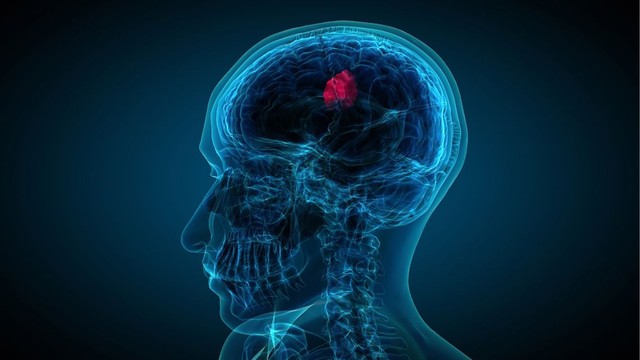 bai-viet/u-tieu-nao-trieu-chung-nhan-biet-phac-do-dieu-tri-va-tien-luong-benh.html